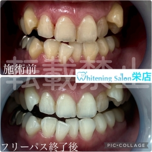 【歯のブリッジの仕組みとは】名古屋栄/ホワイトニング