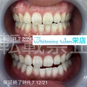 【コーヒー・紅茶で色づく理由】名古屋栄/ホワイトニング