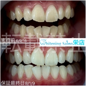 【歯磨きの最適時間は何分？】名古屋栄/ホワイトニング