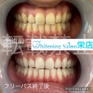 【歯の溝が深い人が虫歯になりやすい】名古屋栄/ホワイトニング