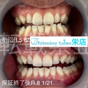 【結婚式前のブライダルホワイトニング一生の思い出を最高の笑顔で】名古屋栄/ホワイトニング