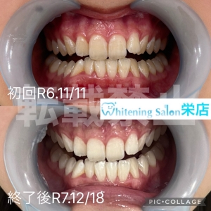 【口臭が起こる本当の原因とは】名古屋栄/ホワイトニング