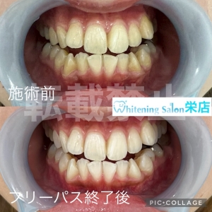 【顎関節症が起こる5つの原因】名古屋栄/ホワイトニング