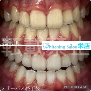 【歯を綺麗に保つ方法とは】名古屋栄/ホワイトニング