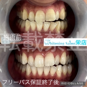 【抜歯後の注意点を知っていますか？】名古屋栄/ホワイトニング