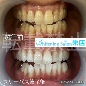 【ホワイトニング直後に避けたい飲み物】名古屋栄/ホワイトニング