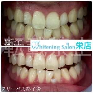 【子供の虫歯リスクが最も高い年齢とは？】名古屋栄/ホワイトニング