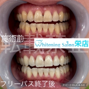 【歯が痛くないのに虫歯がある？】名古屋栄/ホワイトニング