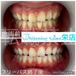 【歯ブラシの硬さの使い分け】名古屋栄/ホワイトニング