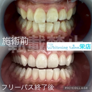 【歯並びが気になる方へ、歯列不正の種類とは】名古屋栄/ホワイトニング