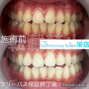 【マウスピース矯正で滑舌は悪くなる？】名古屋栄/ホワイトニング