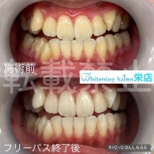 【歯に食べ物が挟まって痛いのは食方圧入】名古屋栄/ホワイトニング