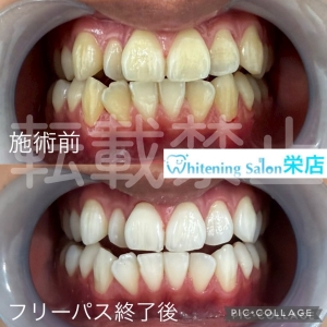 【歯周病から6つの病気になる？！】名古屋栄/ホワイトニング