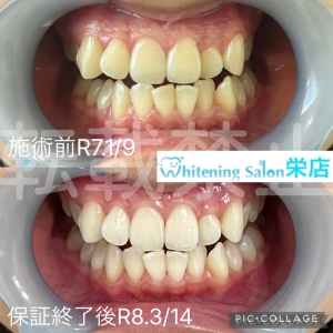 【歯磨きのベストタイミング】名古屋栄/ホワイトニング