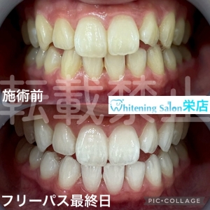 【歯茎の腫れ、出血の原因や対処法】名古屋栄/ホワイトニング