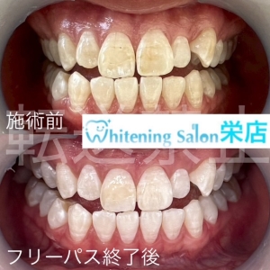 【コーヒー・紅茶で色がつく理由】名古屋栄/ホワイトニング