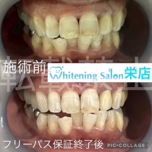 【冬は「歯のメンテナンス月間」】名古屋栄/ホワイトニング