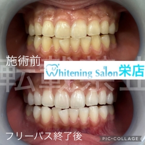 【虫歯になりにくい食生活とは？】名古屋栄/ホワイトニング