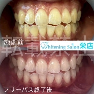 【虫歯が原因で頭痛が起きる？】名古屋栄/ホワイトニング