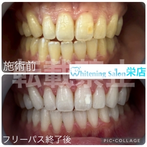 【歯石を放っておくとどうなる？】名古屋栄/ホワイトニング