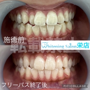 【舌をよく噛んでしまう原因とは】名古屋栄/ホワイトニング