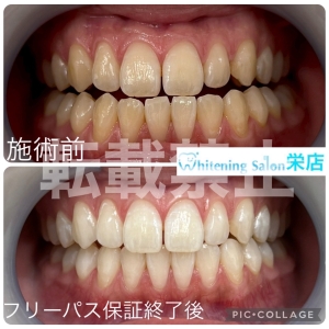 【歯が浮く感じがする？】名古屋栄/ホワイトニング