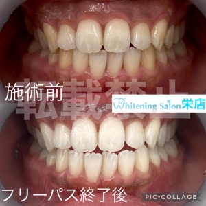 【埋伏歯とは？】名古屋栄/ホワイトニング
